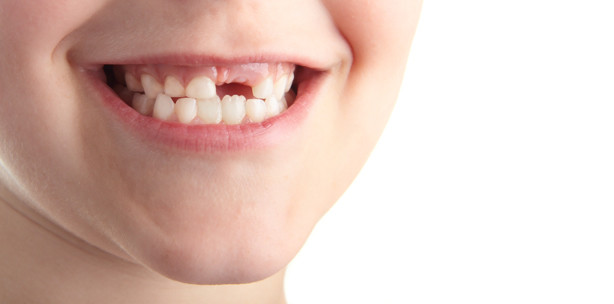 Zu viel Fluorid macht bleibende Zähne fleckig