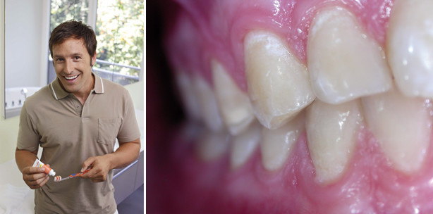 Intensivfluoridierung bei Erwachsenen