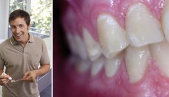 Intensivfluoridierung bei Erwachsenen