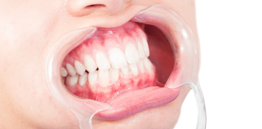 Wichtige Aspekte zum Thema Full Mouth Disinfection