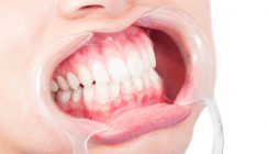 Wichtige Aspekte zum Thema Full Mouth Disinfection