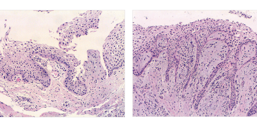 Die follikuläre Zyste –  Schwierigkeiten bei der  präoperativen Röntgendiagnostik