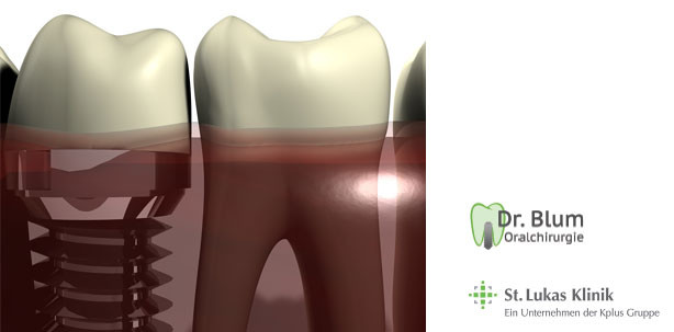 Der erfolgreiche Einstieg in die Implantologie