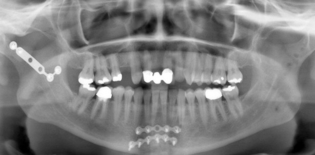 Interdisziplinäre Versorgung von multiplen Frakturen im Ober- und Unterkiefer
