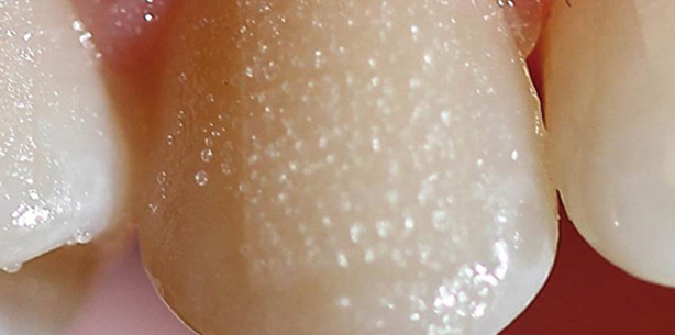 Friction Pads – eine Alternative zu Attachments in der Alignertherapie