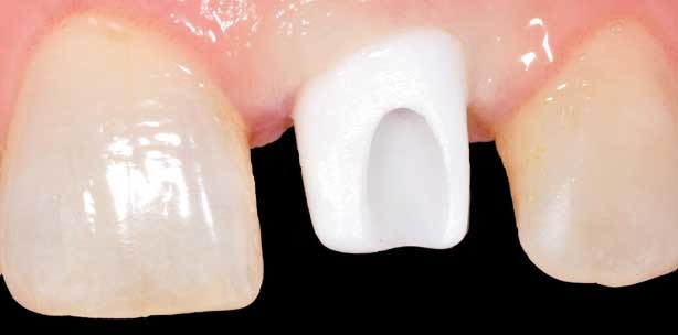 Sofortimplantation nach Unfall – Ästhetik im Frontzahngebiet