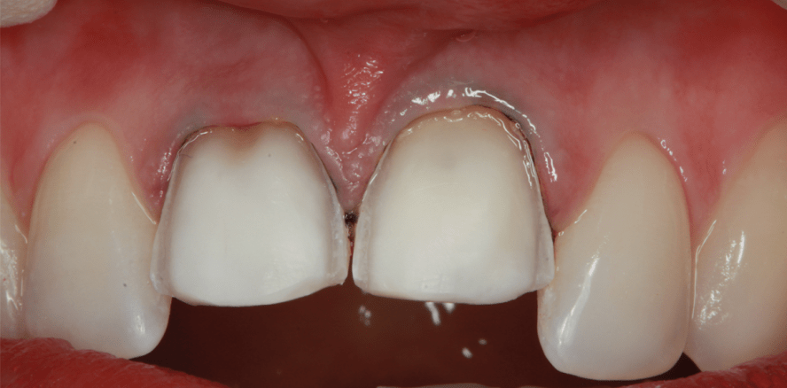 Oberkieferfrontversorgung mit Feldspatkeramikveneers