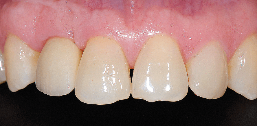 Ästhetik und Funktion im Front- und Seitenzahngebiet