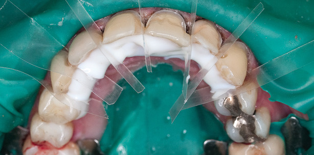 Die innovative Frontzahnrestauration