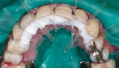 Die innovative Frontzahnrestauration