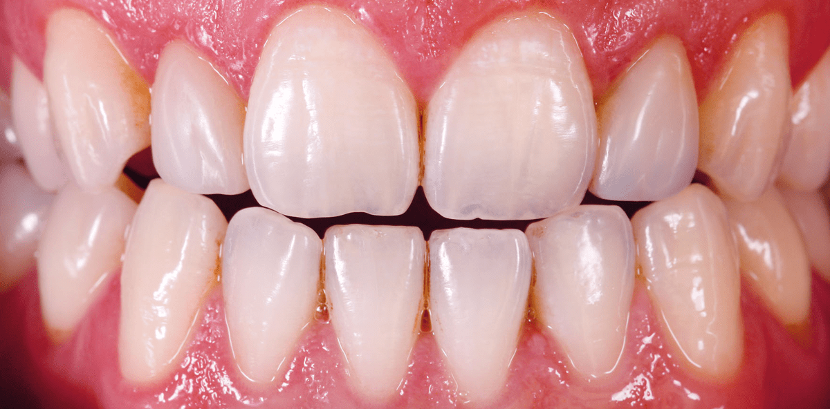 Direkte minimalinvasive Frontzahnrestauration