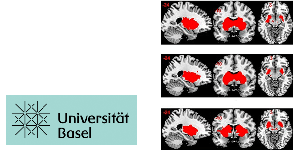 Fruchtzucker erzeugt weniger Belohnungsgefühle im Gehirn