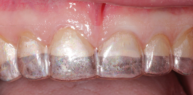 Full Mouth Rehab auf Lithiumdisilikat-Glaskeramikbasis