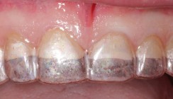 Full Mouth Rehab auf Lithiumdisilikat-Glaskeramikbasis