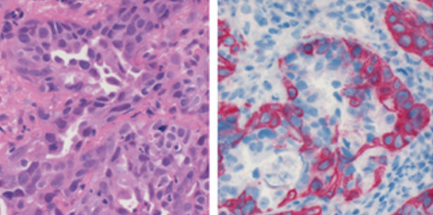 Pathologie und histopathologische Prognosefaktoren oraler Karzinome