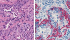 Pathologie und histopathologische Prognosefaktoren oraler Karzinome