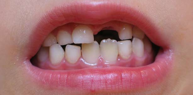 Therapie beim Zahnunfall – was ist zu tun?