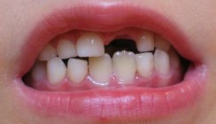 Therapie beim Zahnunfall – was ist zu tun?