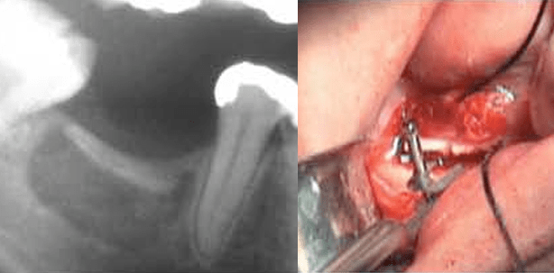 Die Garagentordistraktion: Eine Möglichkeit der Augmentation im distalen Unterkiefer