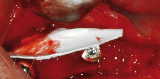 Neue Materialien in der GBR