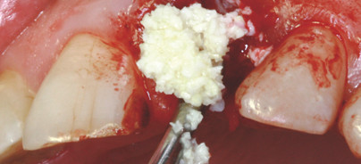 Sichere Knochen­regeneration durch neue Kollagenmembran