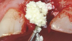 Sichere Knochenregeneration durch neue Kollagenmembran