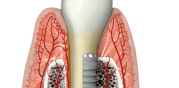 Gingiva-Biotyp: Einfluss auf chirurgisch-restaurative Implantattherapie