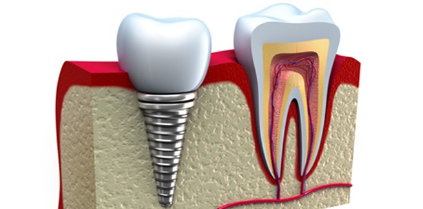 Protein-Gel für schnelle Osseointegration