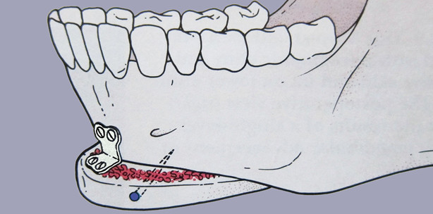 Methode und Wirkungsweise der Genioplastik