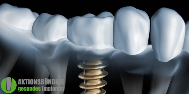 Bündnis für Implantatgesundheit wächst weiter