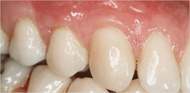 Deckung von gingivalen Rezessionen