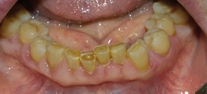 Gingivahyperplasie als Nebenwirkung des Kalziumkanalblockers Amlodipin