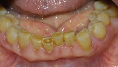 Gingivahyperplasie als Nebenwirkung des Kalziumkanalblockers Amlodipin