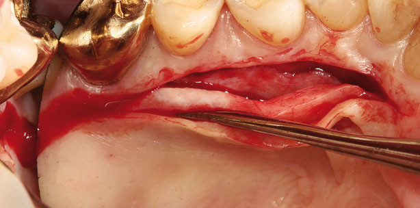 Gingivatransplantate im Frontzahnbereich