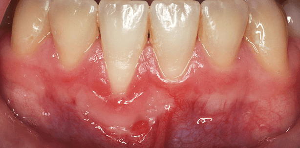 Freies Schleimhauttransplantat zur Augmentation der Gingiva