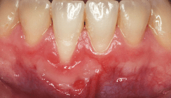 Freies Schleimhauttransplantat zur Augmentation der Gingiva
