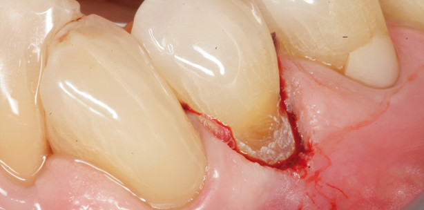 Duty Cycle: Akademischer Begriff oder von klinischer Relevanz?