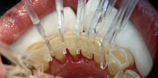 Vorimprägniertes Glasfaserband in der Parodontologie