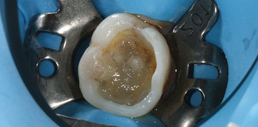 Faserverstärkte Komposite optimal kombiniert mit Verstärkungsfasern