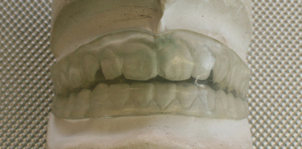 Die labortechnische Herstellung des gnathologischen Positioners