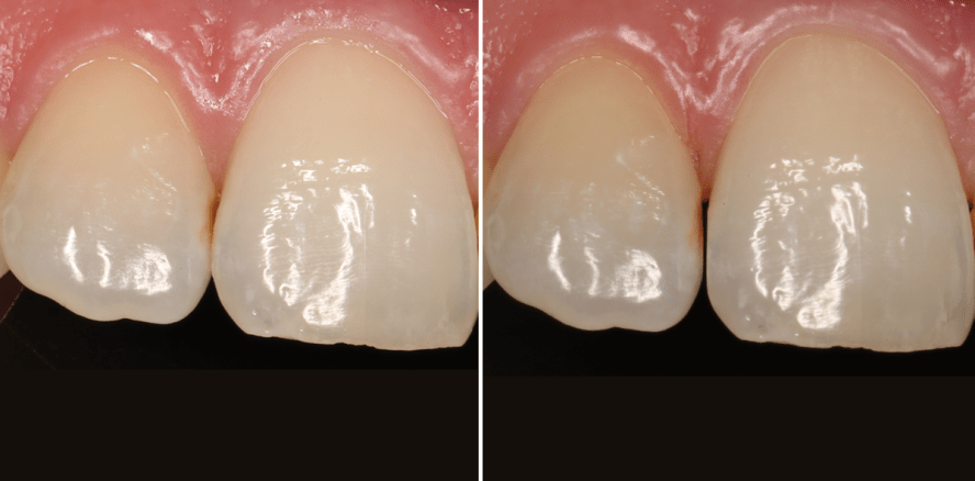 Approximale Schmelzreduktion (ASR) – Routine in der Kieferorthopädie?