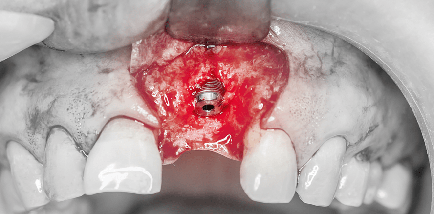 Implantatfreilegung – den Eingriff sorgfältig dokumentieren