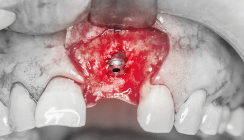 Implantatfreilegung – den Eingriff sorgfältig dokumentieren