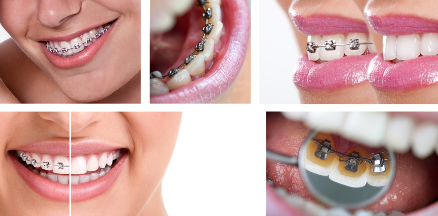 Run auf Gratiszahnspangen bleibt vorerst aus