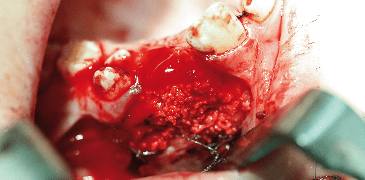 Einsatz von β-Tricalciumphosphat versus Hydroxylapatitkeramik