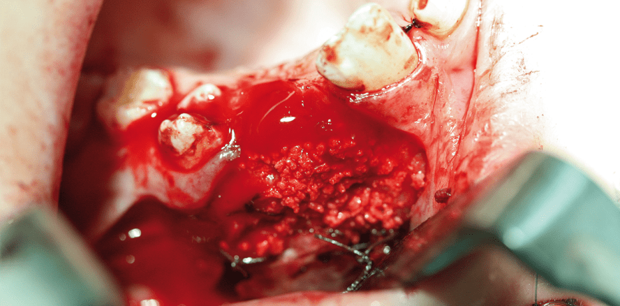 Einsatz von β-Tricalciumphosphat versus Hydroxylapatitkeramik