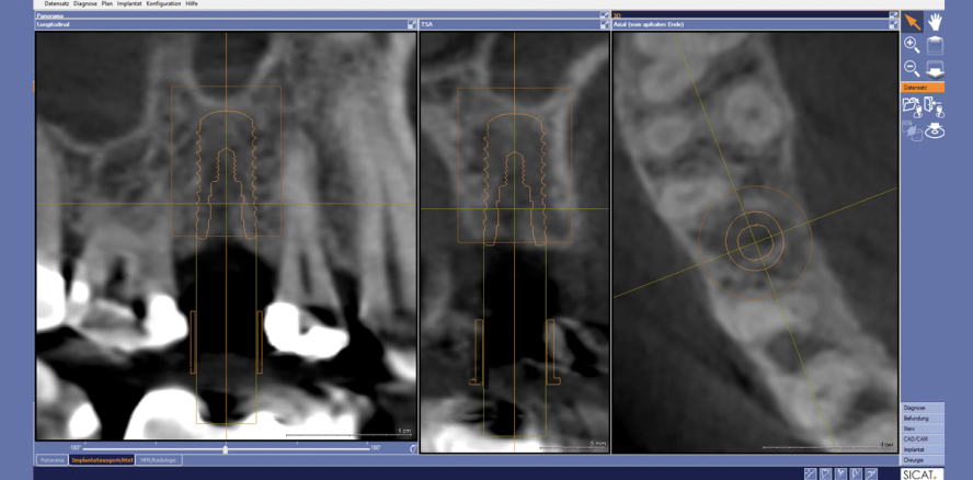 Guided Implant Surgery – eine Literaturrecherche