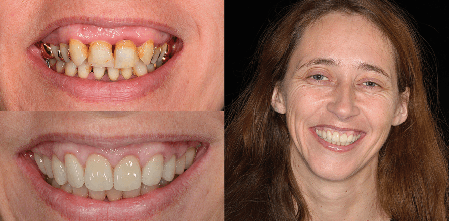 Korrektur eines Gummy Smile in Verbindung mit einer ästhetischen Gesamtrehabilitation