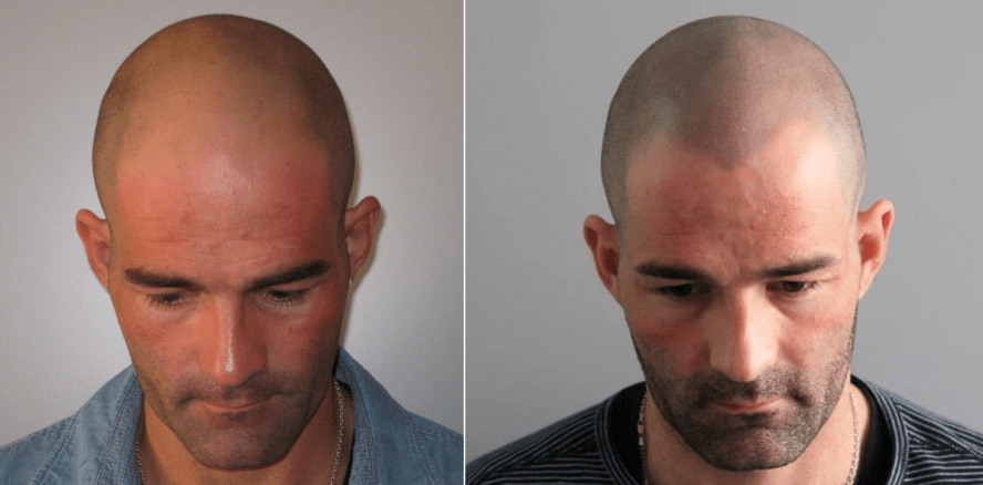 Haar-Tattoo gibt Männern Selbstvertrauen zurück