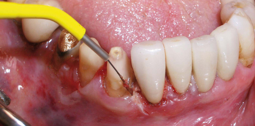 Kompakt und effizient für die Weichgewebechirurgie